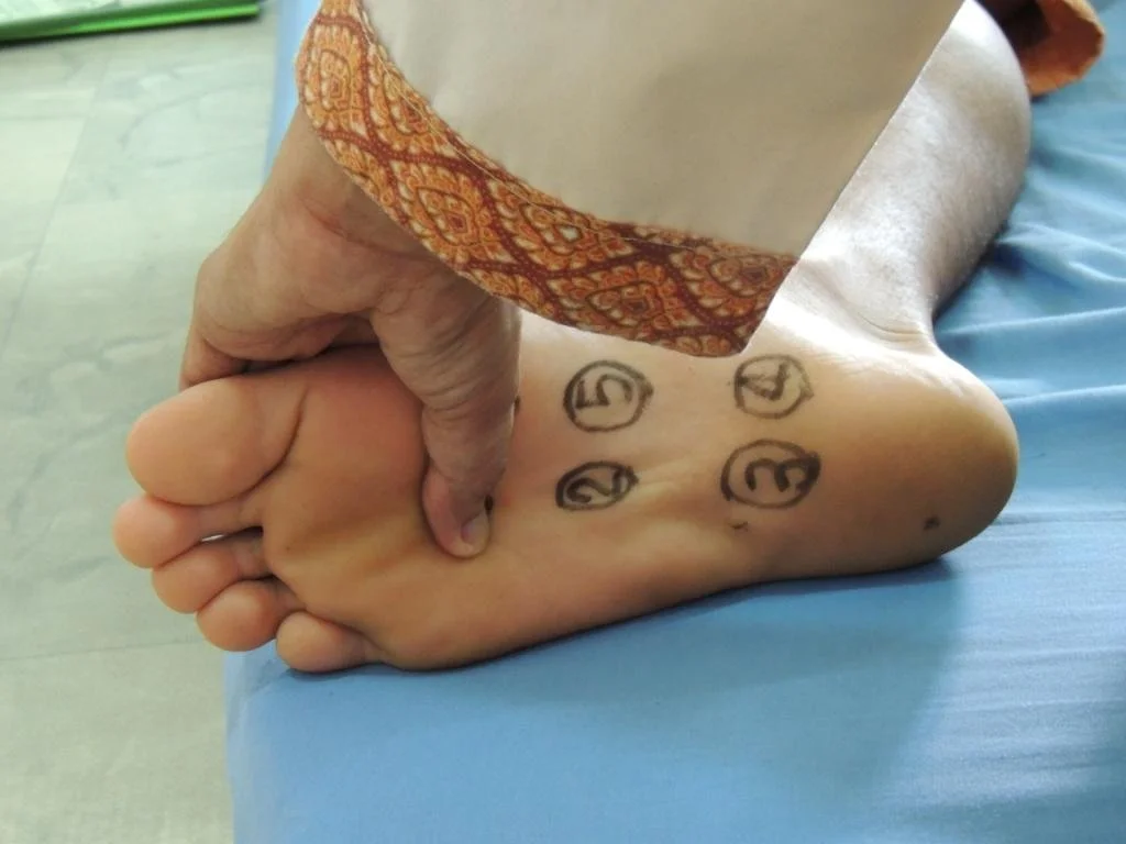 A close view of a thumb pressing into the arch of a bare foot, with four points drawn on the sole in marker and numbered 2, 3, 4 and 5.
